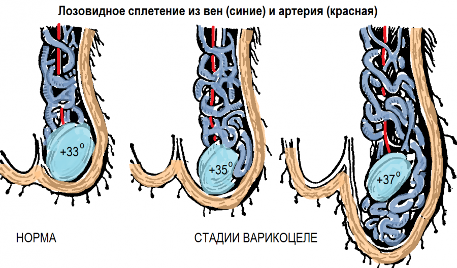 На фото: деформация мошонки на разных стадиях варикоцеле